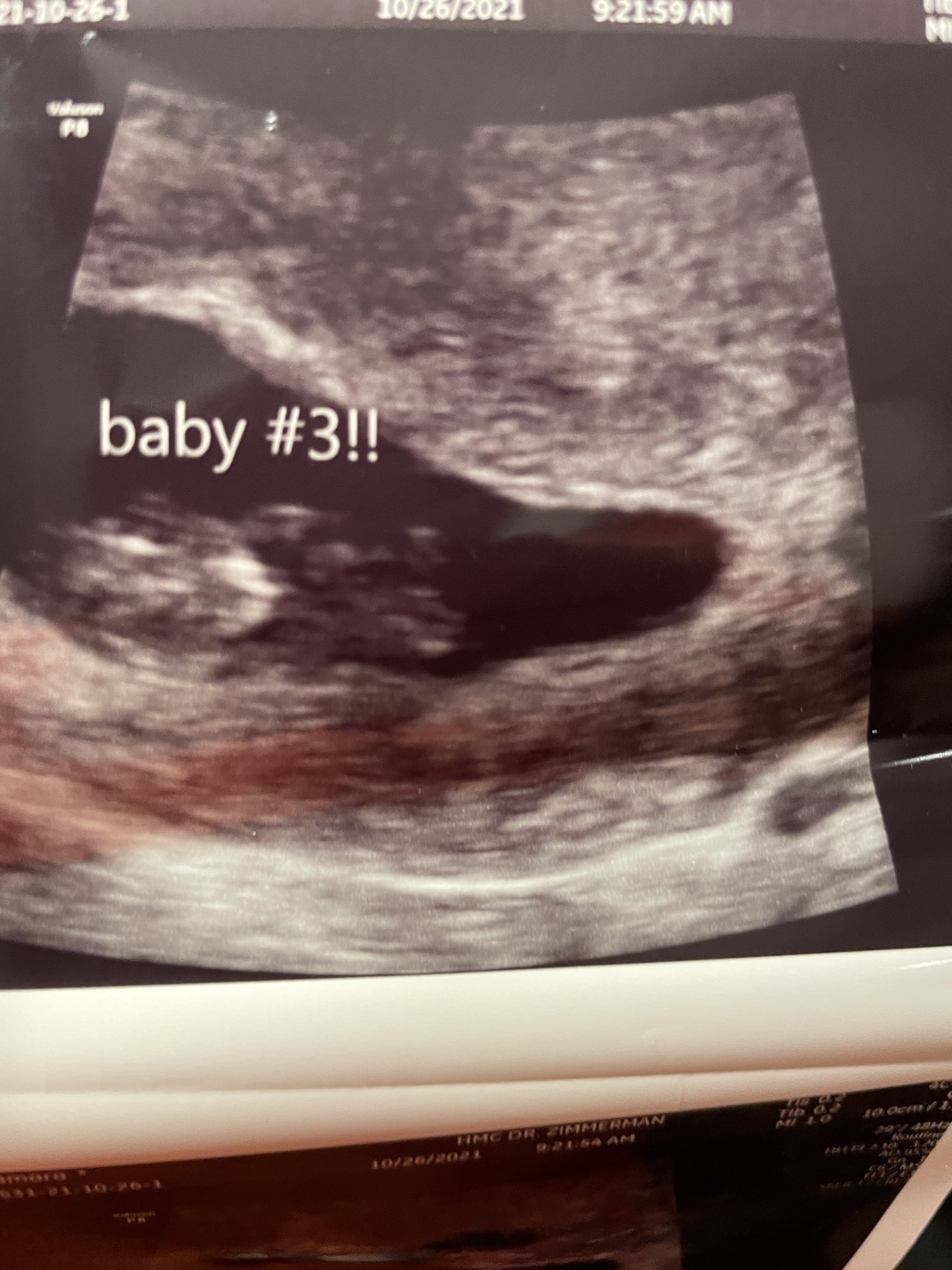 Surrogacy/ miscarried in dec2021. — photo 1 of 2