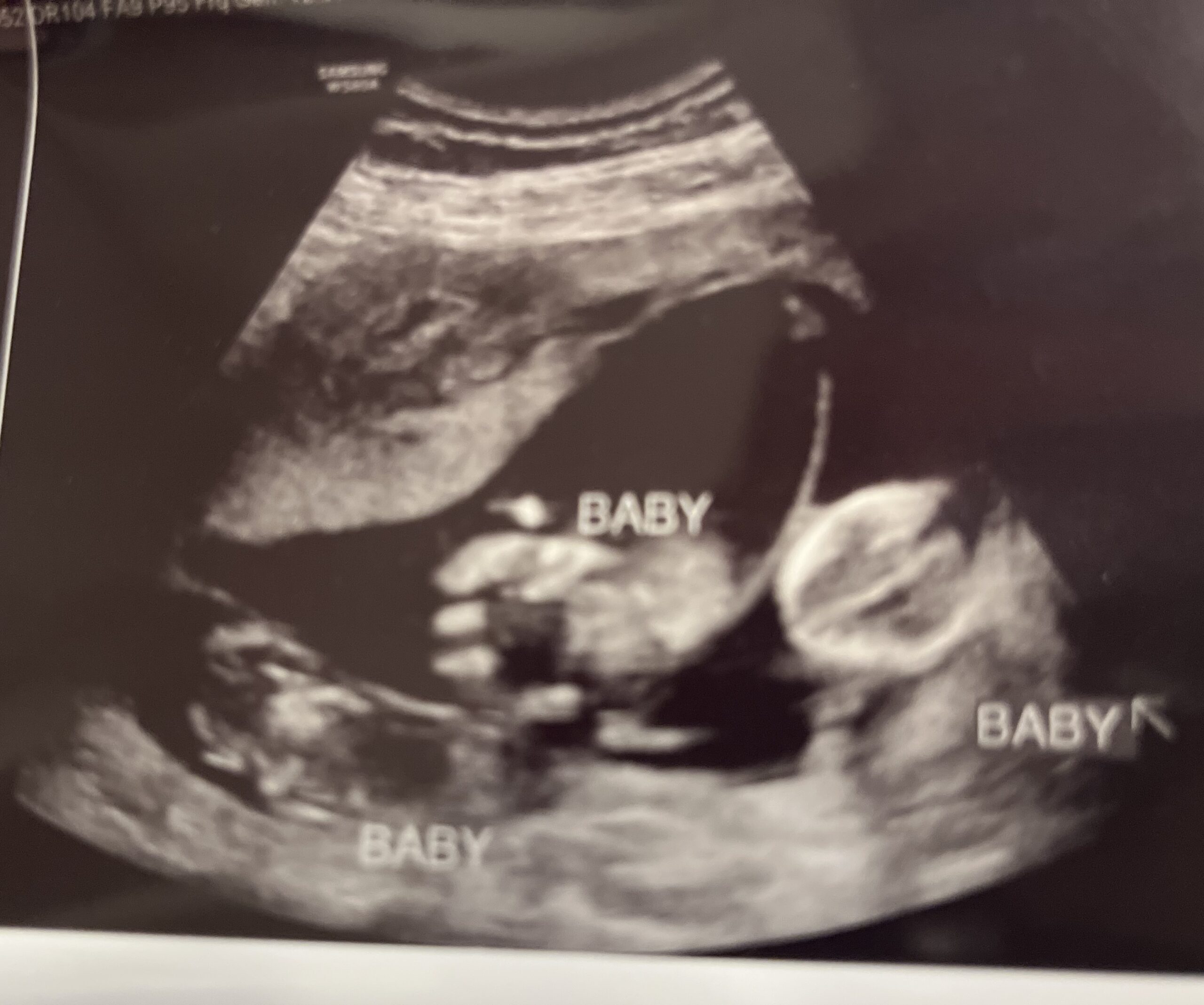 Surprise Triplets! Raising money help — photo 1 of 1